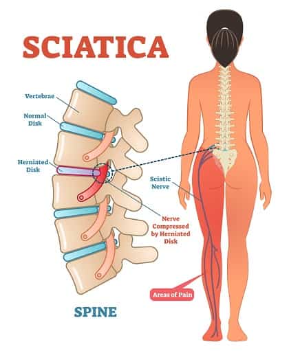 Sciatica and Leg Pain