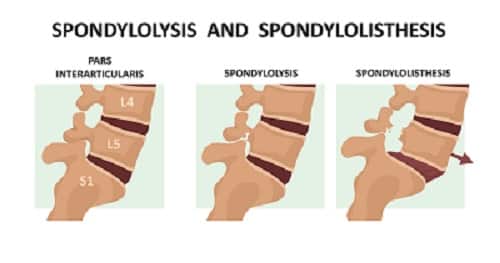 Spondylolisthesis